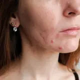 Blizny po pryszczach? Skuteczne metody na gładką cerę i jak im zapobiegać