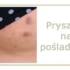 Pryszcze na pośladkach? Poznaj skuteczne metody i gładką skórę!