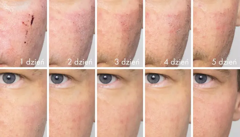 Makijaż po laserze frakcyjnym: Kiedy bezpiecznie, by nie zepsuć efektów?