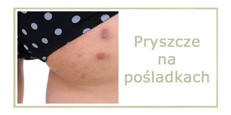 Pryszcze na pośladkach? Poznaj skuteczne metody i gładką skórę!