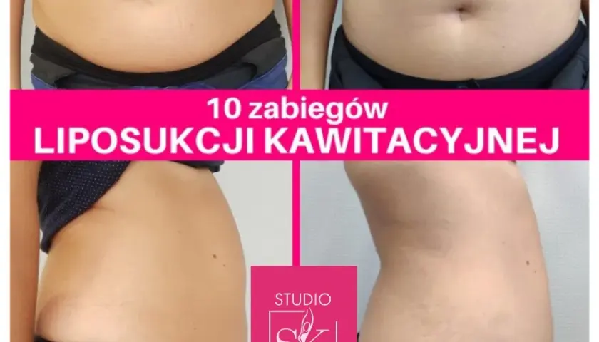Ile zabiegów liposukcji kawitacyjnej? Odkryj swój plan!