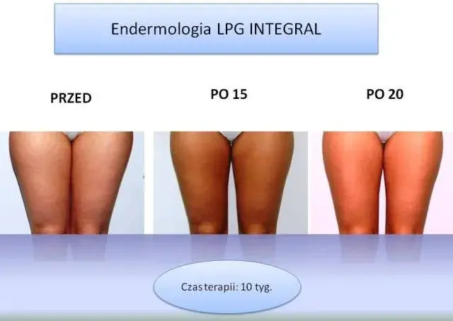 Ile zabiegów endermologii? Od 10 do 20 sesji poznaj plan!